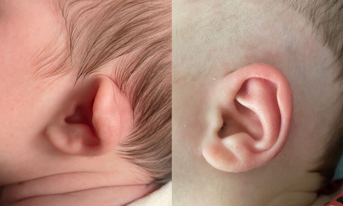 Odstáré boltce, kornoutovité ucho, constricted ear, po léčbě EarWell systémem - Pred a po léčbě