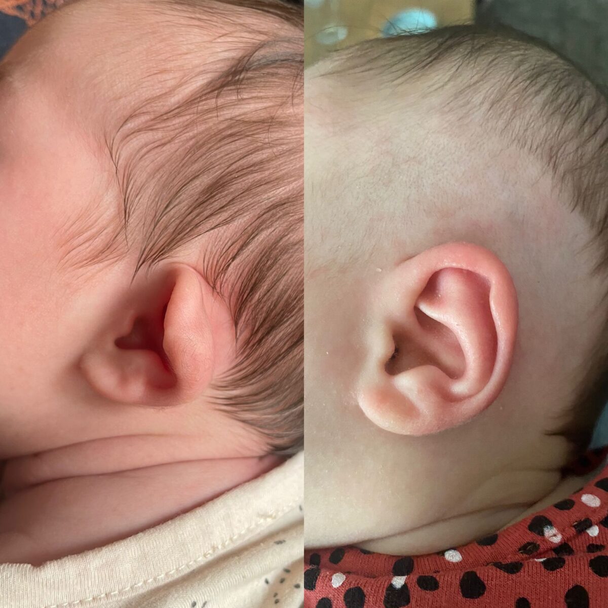 Odstáré boltce, kornoutovité ucho, constricted ear, po léčbě EarWell systémem - Pred a po léčbě