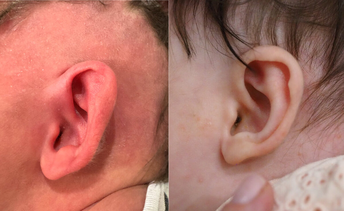 Odstáré boltce po léčbě EarWell systémem - Pred a po léčbě